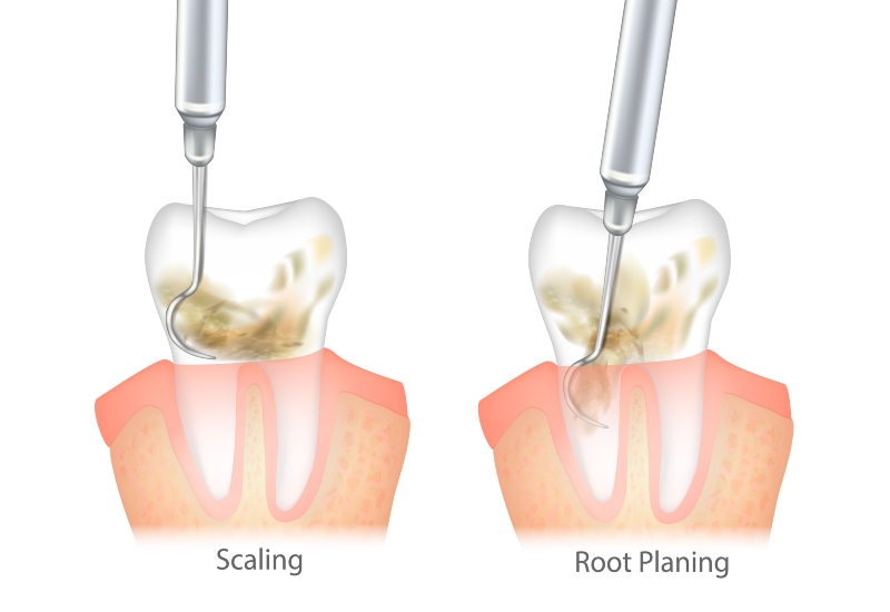 Scaling and root planing 3d illustration