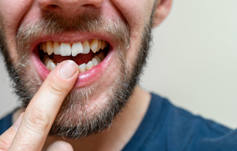 Close-up of a chipped tooth indicating dental damage and the need for treatment in Mokena, IL
